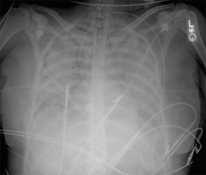 Transfusions anticoagulants and bleeding