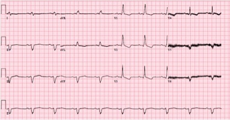 LVAD
