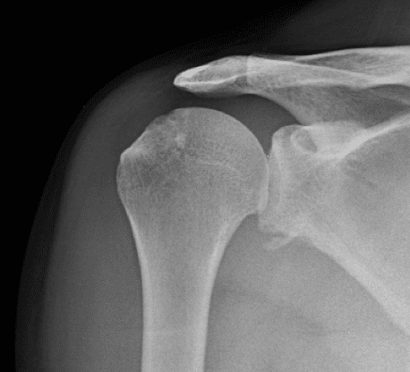 Bony Bankart Lesion x-ray
