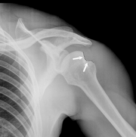 Hill-Sachs deformity shoulder x-ray