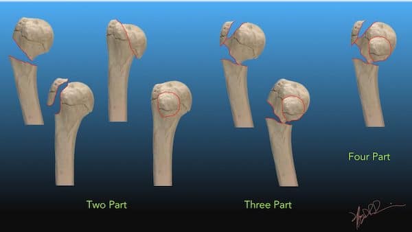 Neer classification