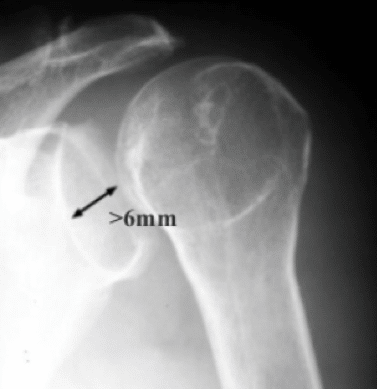 Rim Sign posterior glenohumeral shoulder dislocation