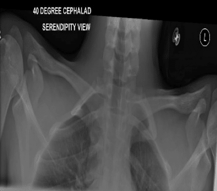 Serendipity view x-ray