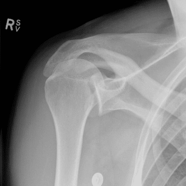 Trough line sign posterior glenohyumeral dislocation