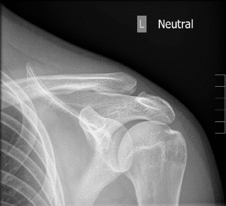 Zanca view x-ray AC joint
