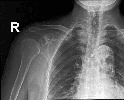 avulsion greater tuberosity fracture
