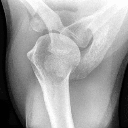 axillary view shoulder x-ray