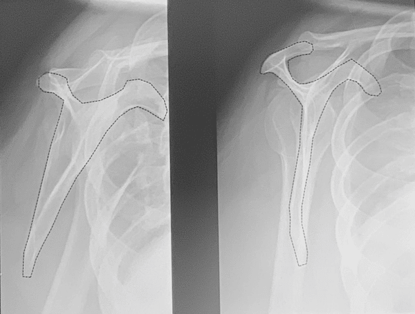 transcapular view x-ray shoulder