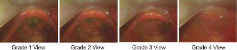 grade 4 view intubation