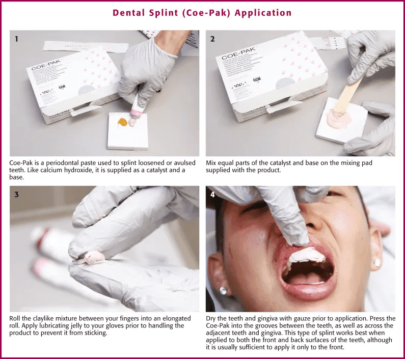 dental splint with coe-pack