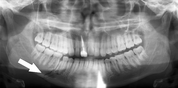 panorex view mandible fracture